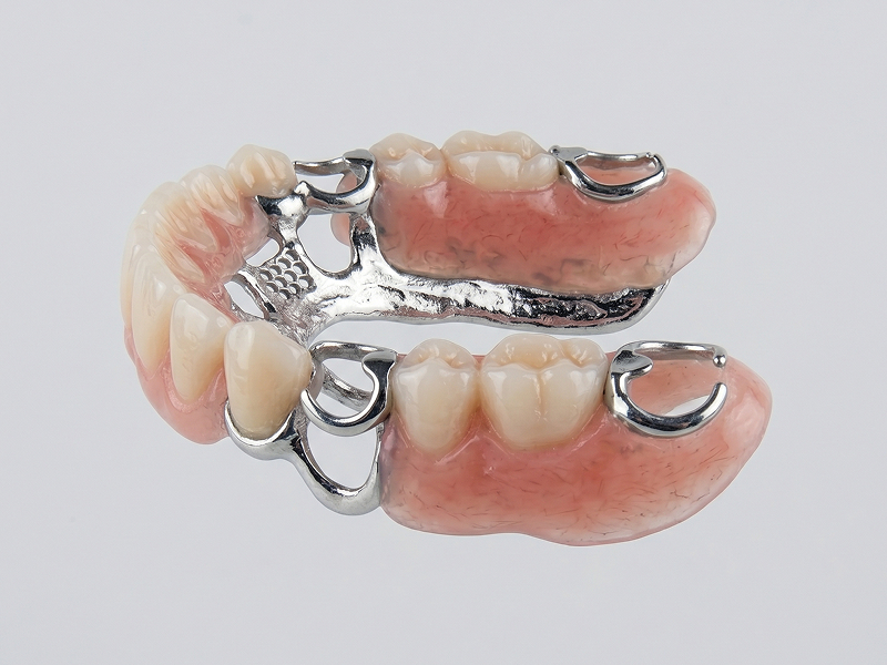 Cast Metal Framework