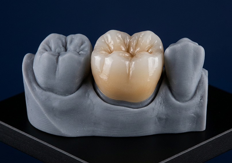 Multilayer zirconia crown seated on a dental model